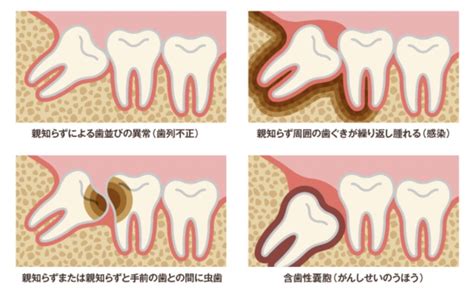 抜歯のギモンについて 親知らずについての質問に答えます 登戸・川崎市多摩区 「登戸グリーン歯科・矯正歯科」