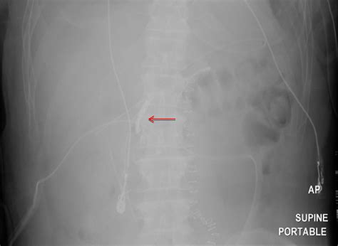 Ap Supine Radiograph Of The Abdomen Demonstrates The Coils Arrow Post