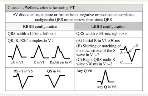 Broad Qrs Complex Ecg