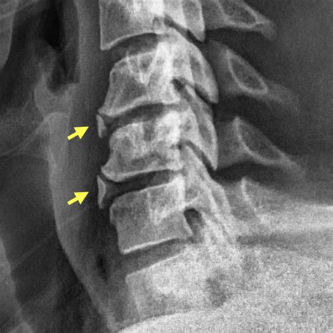 Osteophyte Formation Lumbar Spine