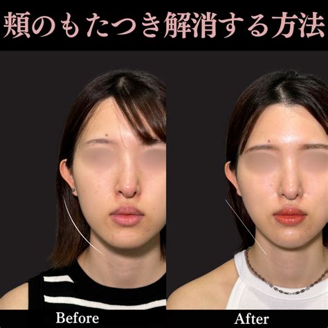 ジョールファット除去 ＋ 糸リフト Prism Beauty Clinic プリズムビューティークリニック 東京 町田・神奈川 相模原の