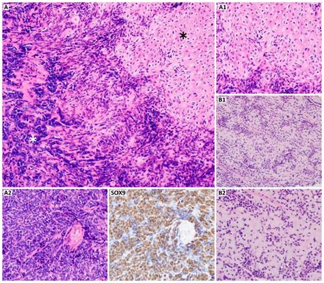 Mesenchymal Chondrosarcoma A He X A Mixture Of Round Cells A