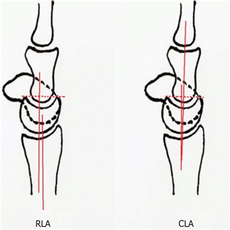 Measured Radiological Parameters Sla Scapholunate Angle Rla