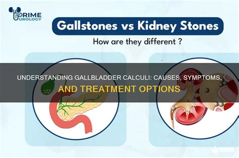 understanding gallbladder calculi  symptoms  treatment
