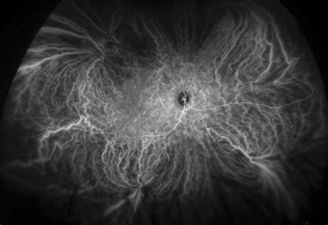 Indocyanine Green Angiography