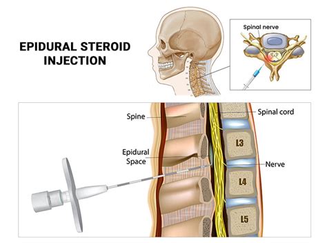 Lumbar Epidural Steroid Injections What It Is Benefits Off