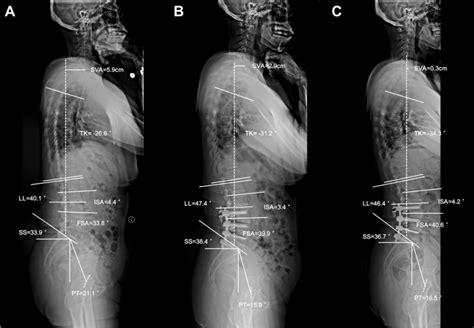 A Year Old Female Patient Underwent L L Ics And L S Tlif With A