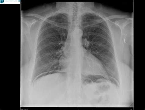 Pathologie Pulmonaire Flashcards Quizlet