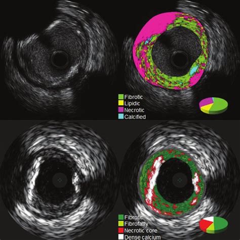 Grey Scale Intravascular Ultrasound And Intravascular Ultrasound Download Scientific Diagram