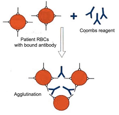 Coombs Test Principle Types Procedure And Result 49 OFF