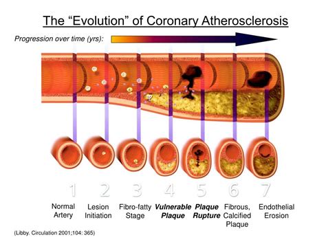 Ppt The Evolution Of Coronary Atherosclerosis Powerpoint