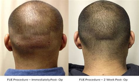 Follicular Unit Extraction Fue Hair Transplant Surgery