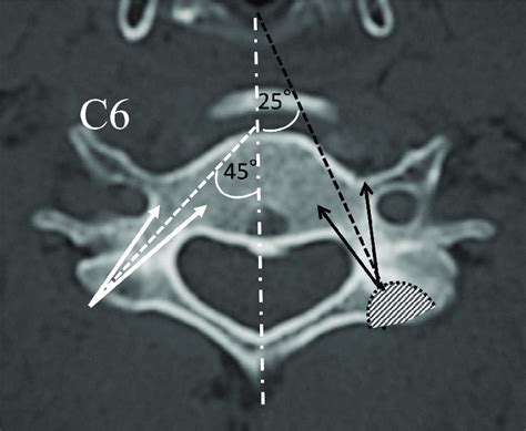 Starting Point And Direction Of Cervical Pedicle Screw White Broken Download Scientific