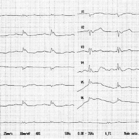 (PDF) Osborn waves due to severe hypothermia