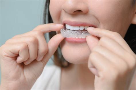 Getting Off Track With Your Invisalign Timeline Here Are 3 Tips To Help Shirck Orthodontics