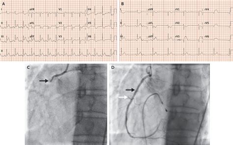 Right Ventricular Infarction Nejm