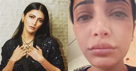 Salaar Actress Shruti Haasan Suffering From This Disease See Pics इस