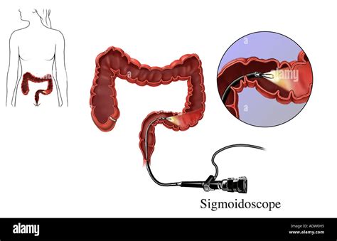 Procédure d une sigmoïdoscopie Colon examen de dépistage du cancer