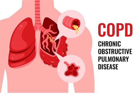 Chronic Obstructive Pulmonary Disease (COPD)