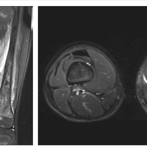 Magnetic resonance imaging (MRI) prior to chemotherapy. MRI revealed ...