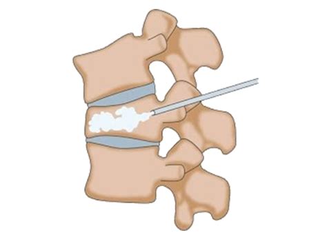 Vertebroplasty Kyphoplasty