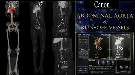 CT LOWER LIMB ANGIOGRAM CT Scan Of Abdominal Aorta Including Run Off