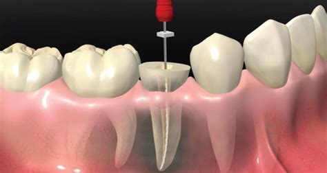 Root Canal Treatment In Abu Dhabi Emirates Royal Center