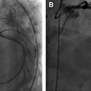 Final Angiogram After Stent Deployment | Download Scientific Diagram