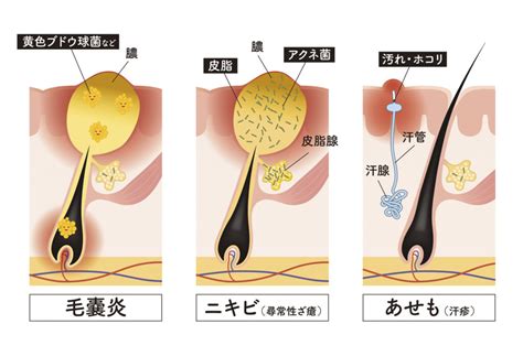 医療脱毛で毛嚢炎ができる原因と早く治す方法を医師が解説｜クレストスキンクリニック公式｜ブログ