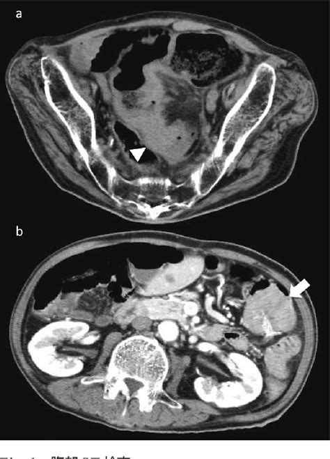 Figure 1 From A Case Of Intussusception Caused By Trans Anal Ileus Tube Ninsertion For