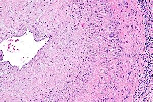 Giant cell arteritis - Libre Pathology