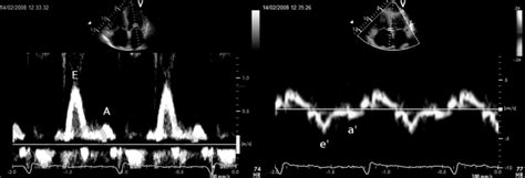 Typical Morphological Findings In Patient With Amyloid Cardiomyopathy