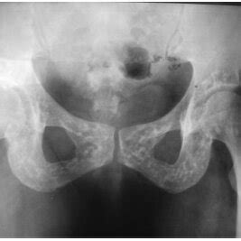 X Ray Of The Patient Pelvis Showing Multiple Symmetric And Sclerotic