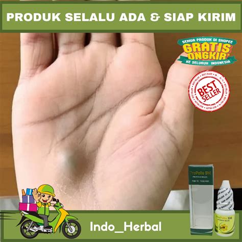 Jual Obat Pengempis Benjolan Di Telapak Tangan Benjolan Lemak