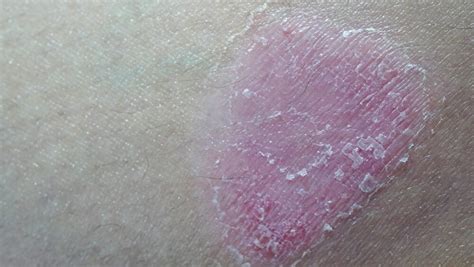 Tapinarof Cream Looks Promising for Plaque Psoriasis - Dermatology Advisor