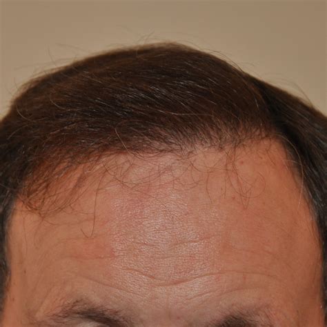 1000 Graft Hair Transplant Coverage Costs Results