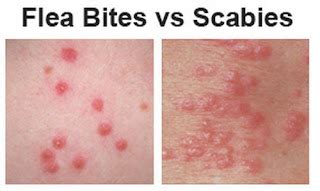 Scabies Rash Pictures | Medical Pictures and Images - (2018 Updated)