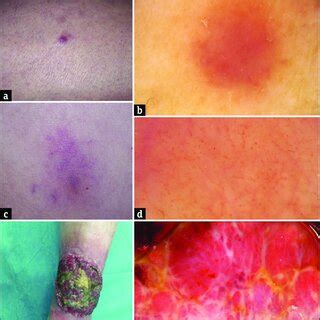 (a and b) LC in the course of acute monocytic leukemia (Patient 1 ...