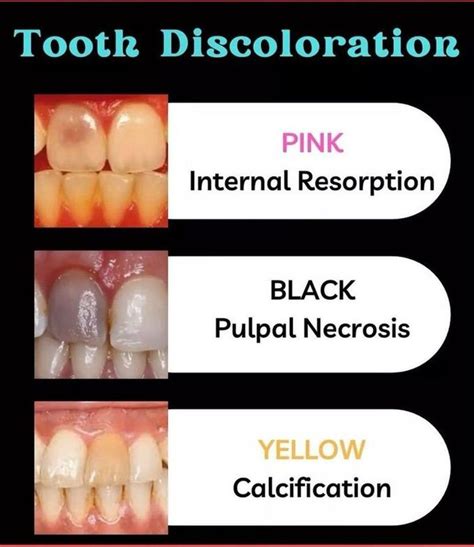 Tooth Discolouration Medizzy