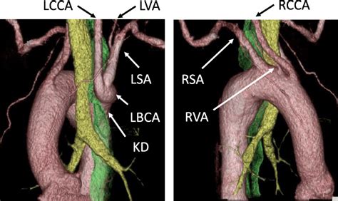 Three Dimensional Computed Tomography Showing The Rightside Aortic Arch Download Scientific