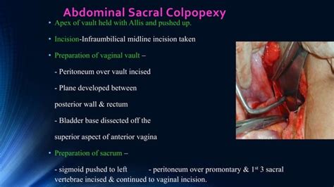 Vault Prolapse Pelvic Organ Prolapse Supports Of Uterus Ppt