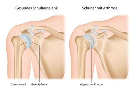 Arthrose Der Schulter Omarthrose Symptome Behandlung