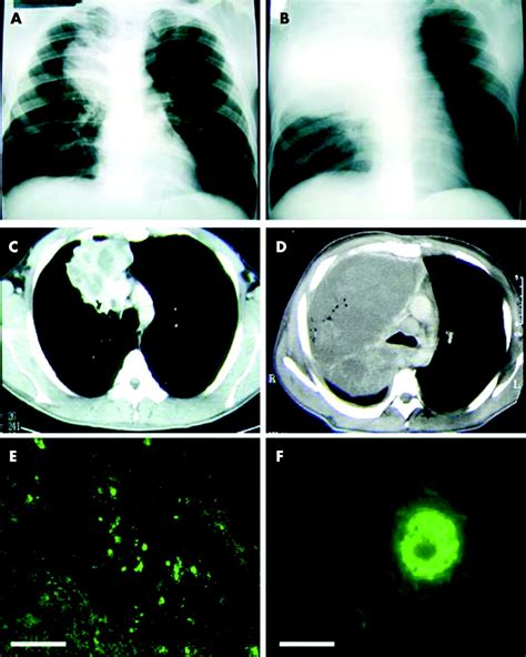 Pulmonary Amoebiasis Presenting As Superior Vena Cava Syndrome Thorax