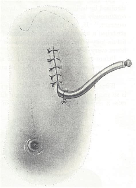 Laparotomy Temporary Exhibition — Worcester Medical Museums