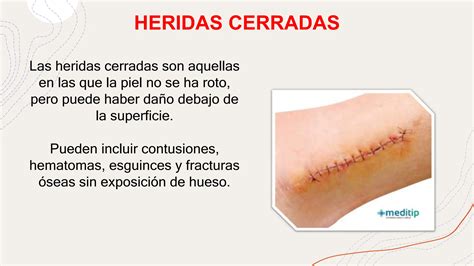 Todos Los Tipos De Heridas Y Su Tratamiento Ppt