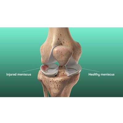 Meniscus Injury Rapid Physiocare