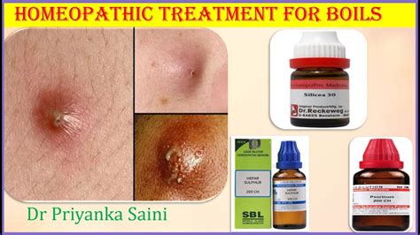 Homeopathy Treatment For Boilfrunclecarbuncleabscess Pus In Boil