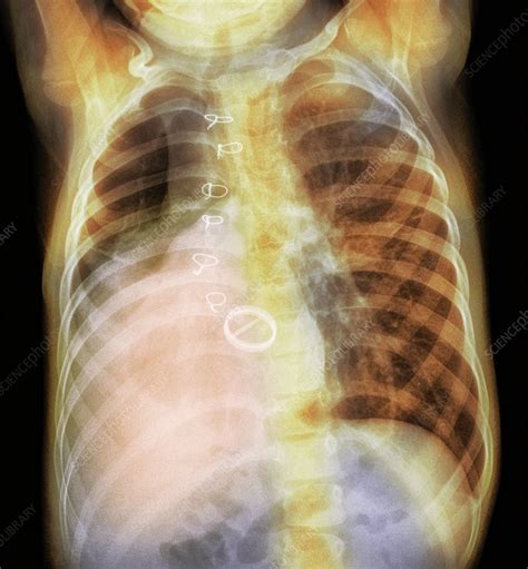 Pneumonia X Ray Stock Image C011 9716 Science Photo Library