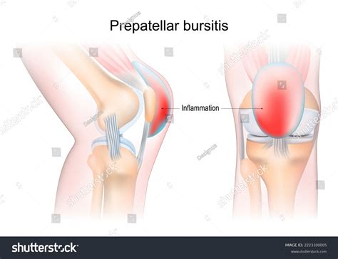 bursitis. Prepatellar bursitis. inflammation of - Royalty Free Stock Vector 2223100005 - Avopix.com