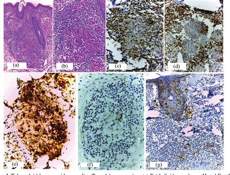 Figure 1 from Immunohistochemistry of skin lesions in leprosy and ...